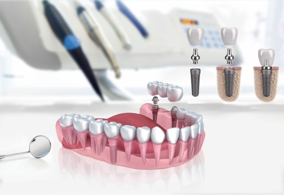 Implant dentaire : pourquoi le dentiste le préconise ?