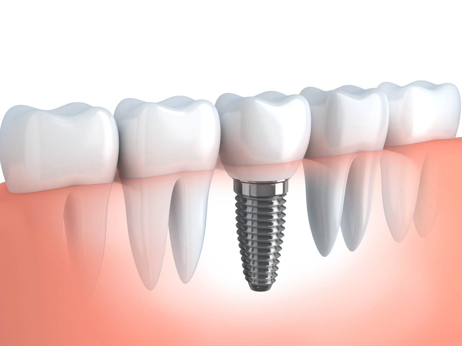 Implant dentaire : Comment elle fonctionne la dent ?
