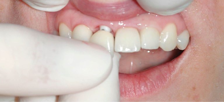 Implant dentaire : pourquoi le dentiste le préconise ?